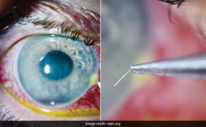 Read more about the article Man In US Left With Stinger In Eye After Bee Attack