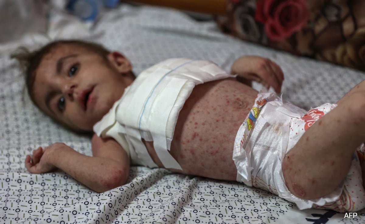 Dangerous Skin Diseases Spreading Among Malnourished Children In Gaza