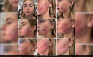 Read more about the article UK Woman, 24, Left With Second-Degree Burns And Scarring After Microneedling