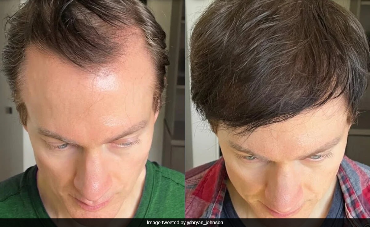 Tech Millionaire Bryan Johnson Reveals How He Reversed His Hair Loss, Shares Tactics