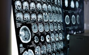 Read more about the article A 5-Minute Brain Scan Can Reveal Risk Of Psychosis In Patients: Study