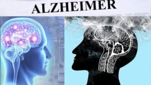 Read more about the article The alarming rise in Alzheimer’s cases and its impact on global health – Firstpost