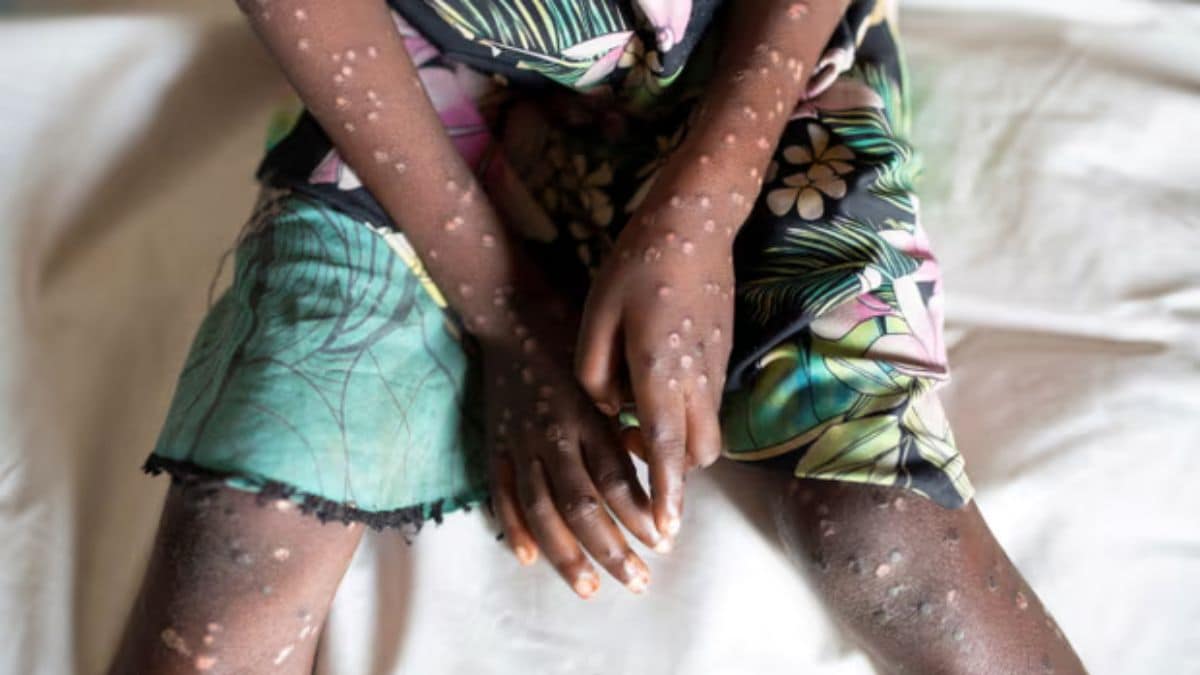 Read more about the article Can the deadly new mpox strain in Africa ignite another global outbreak? – Firstpost