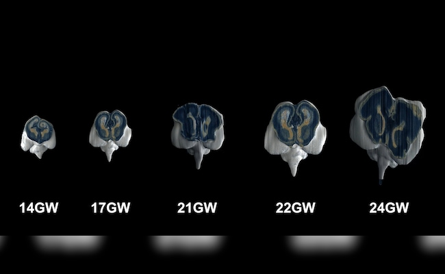 IIT Madras Captures Images Of Fetal Brain, World's Most Detailed Yet